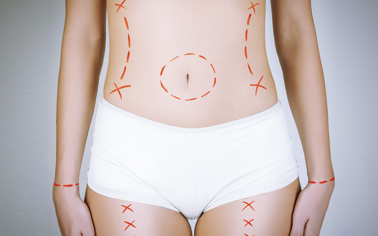 Abdominoplastie