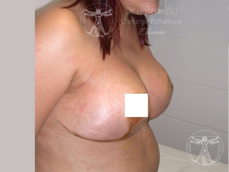 Cas 1  - Après de profil