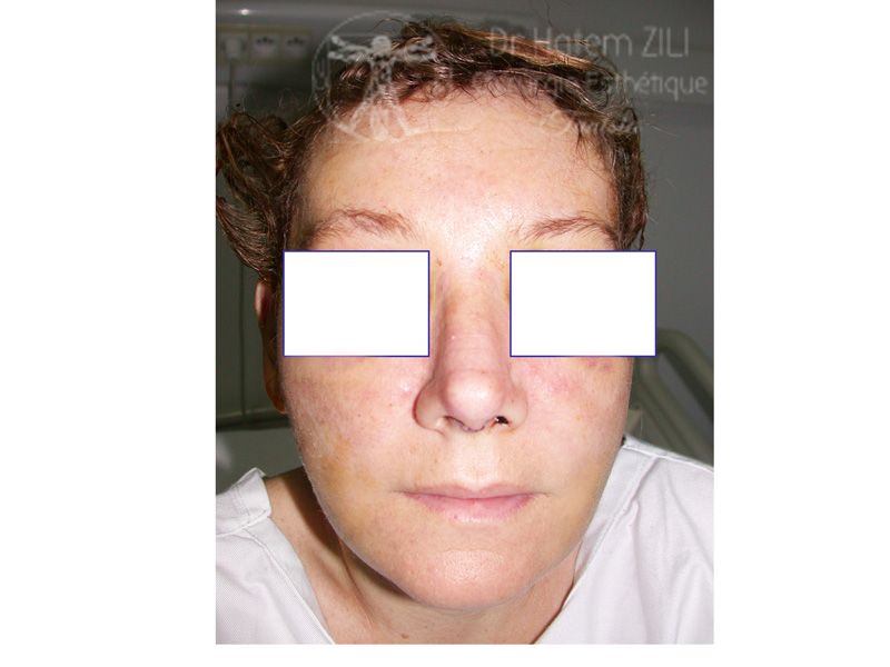 Rhinoplastie Après