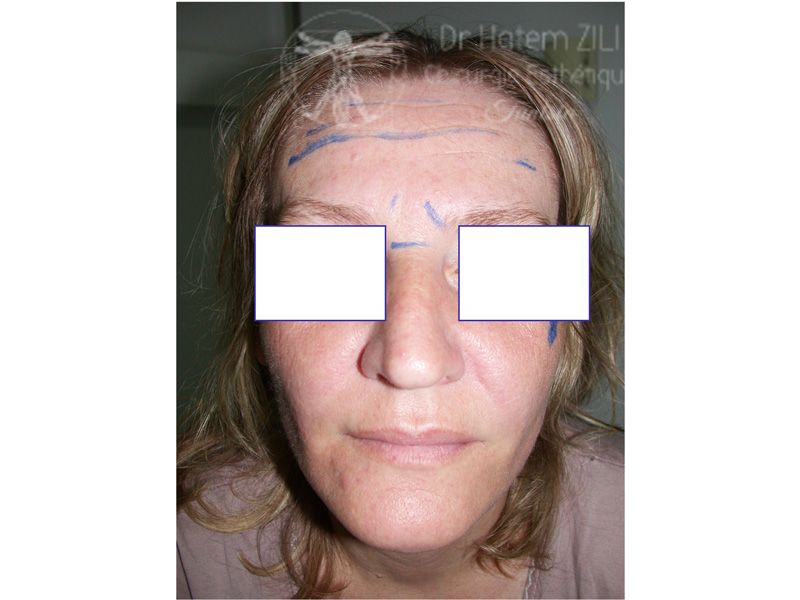 Rhinoplastie Avant intervention