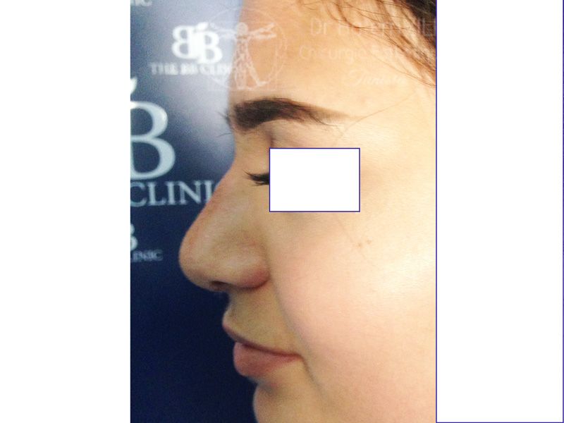 Rhinoplastie Après