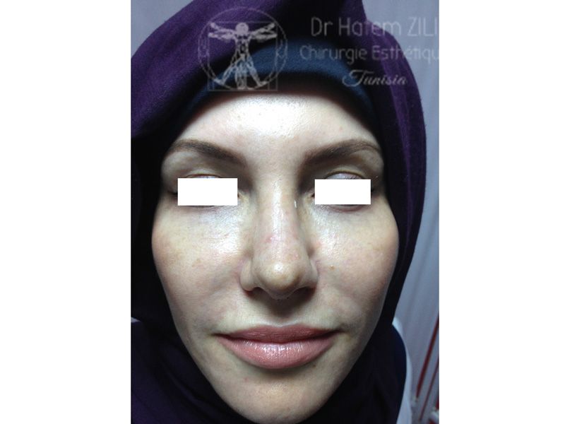 Rhinoplastie Après